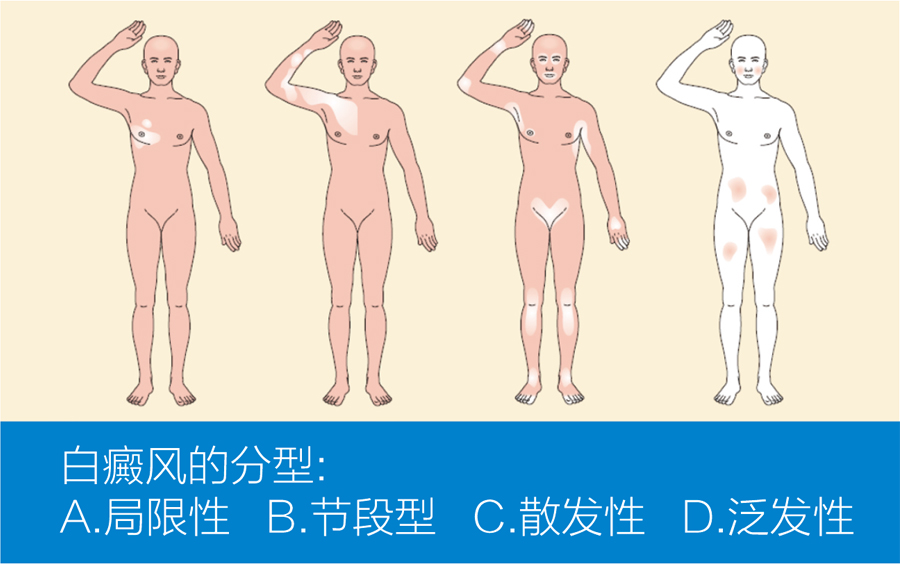 王宏偉教授專欄|白癜風(fēng)相關(guān)知識(shí)科普(圖2)